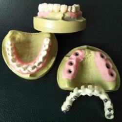 Midway Dental Lab: Precision Crafted Dental Implant Crowns for a Perfect Smile